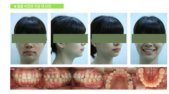 얼굴사진과 구강내 사진