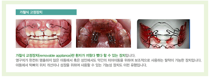 가철식교정장치