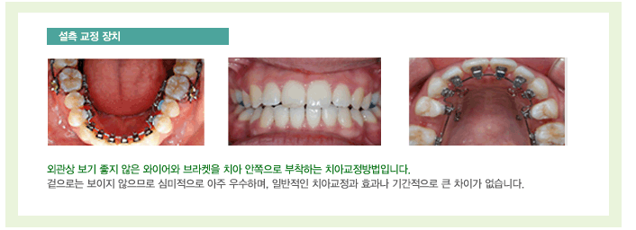 설측교정장치