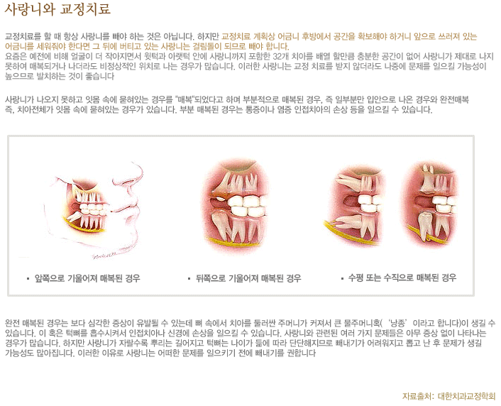 사랑니